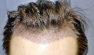 dhi Hair Transplantation