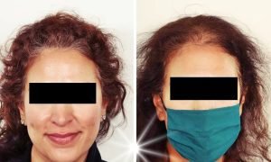 women hair transplant