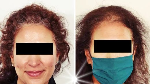 women hair transplant